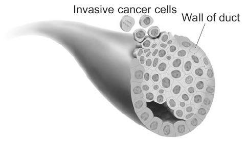 This picture shows ductal carcinoma in situ.